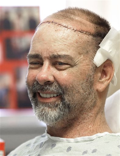 Texas doctors do world’s first skull-scalp&nbsp;transplant