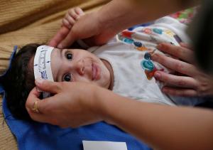 FILE - In this Wednesday, Feb. 24, 2016 file photo, 3-month-old Esther Kamilly has her head measured by Brazilian and U.S. health workers from the United States' Centers for Disease Control and Prevention (CDC) at her home in Joao Pessoa, Brazil, as part of a study on the Zika virus and the birth defect microcephaly. As the international epidemic of Zika has unfolded and led to devastating birth defects for at least 1,300 children in eight countries, an agonizing question has persisted: What is the chance that an infected pregnant woman will have a baby with these defects? (AP Photo/Andre Penner)
