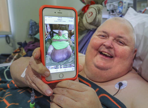 Doctor removes 130-pound tumor from Mississippi&nbsp;man